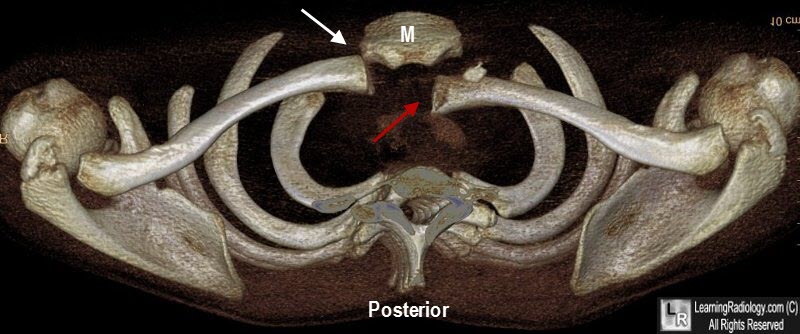 Posterior Dislocation of the Left Sternoclavicular Joint